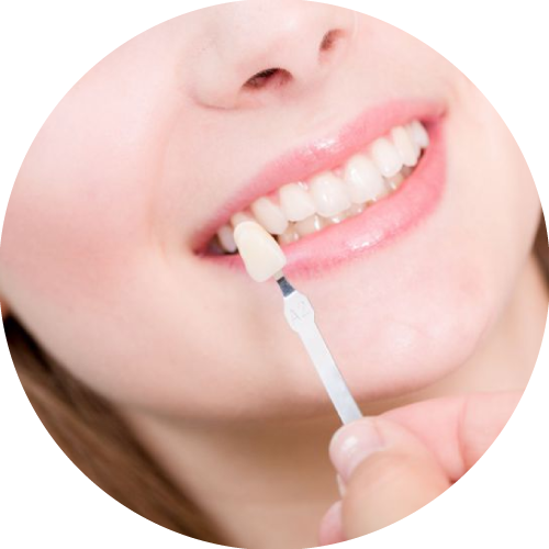 Venha fazer uma avaliação para obter as lentes de contato dental lentes de contato dental e facetas de porcelana